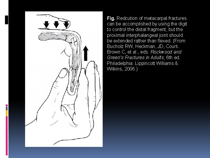Fig. Redcution of metacarpal fractures can be accomplished by using the digit to control