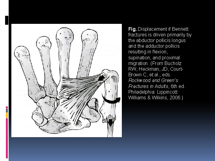 Fig. Displacement if Bennett fractures is driven primarily by the abductor pollicis longus and