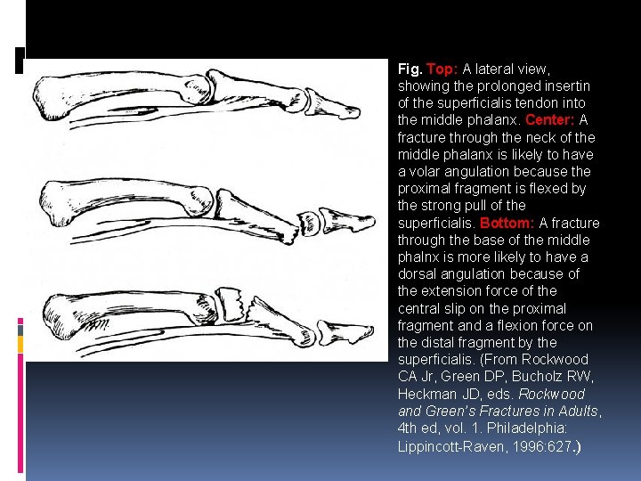 Fig. Top: A lateral view, showing the prolonged insertin of the superficialis tendon into