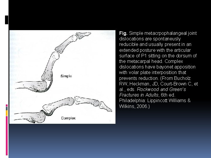 Fig. Simple metacrpophalangeal joint dislocations are spontaneusly reducible and usually present in an extended