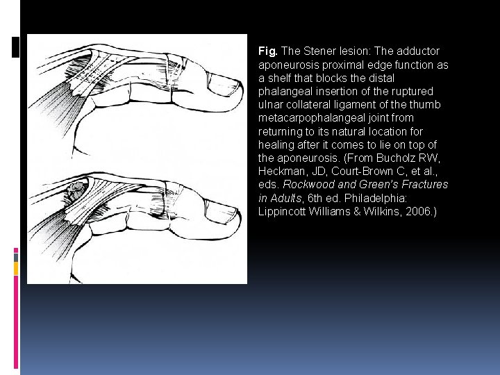 Fig. The Stener lesion: The adductor aponeurosis proximal edge function as a shelf that