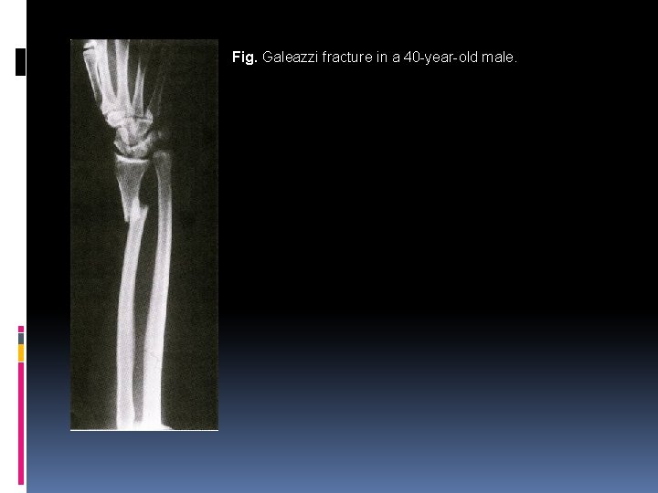 Fig. Galeazzi fracture in a 40 -year-old male. 
