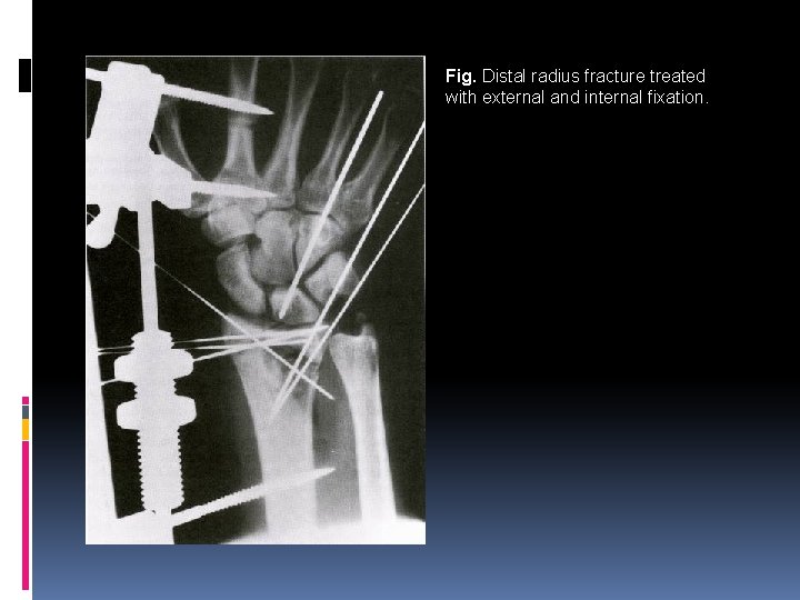 Fig. Distal radius fracture treated with external and internal fixation. 