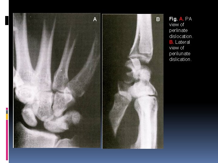 A B Fig. A. PA view of perlinate dislocation. B. Lateral view of perilunate