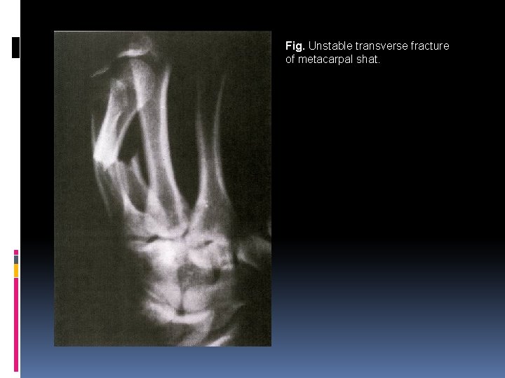 Fig. Unstable transverse fracture of metacarpal shat. 