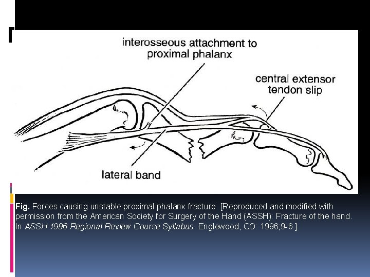 Fig. Forces causing unstable proximal phalanx fracture. [Reproduced and modified with permission from the