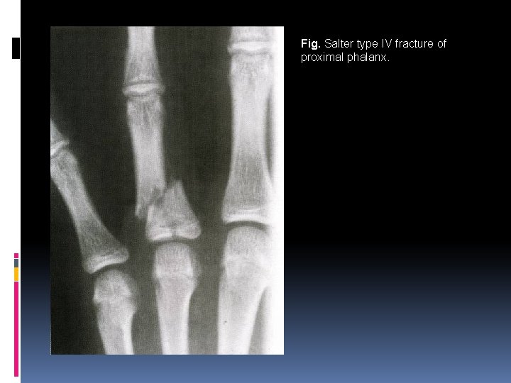 Fig. Salter type IV fracture of proximal phalanx. 