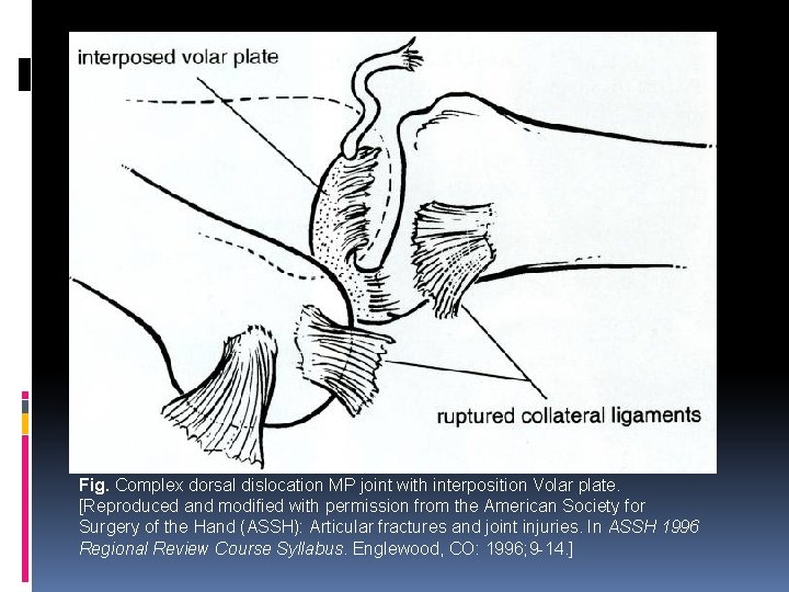 Fig. Complex dorsal dislocation MP joint with interposition Volar plate. [Reproduced and modified with