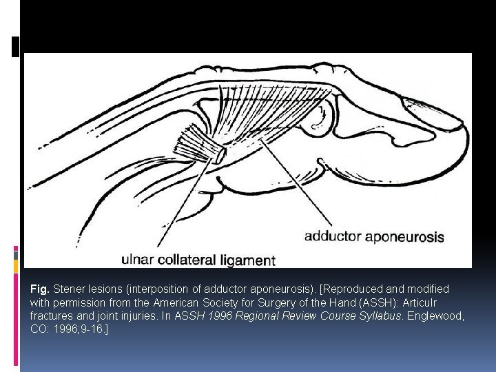 Fig. Stener lesions (interposition of adductor aponeurosis). [Reproduced and modified with permission from the