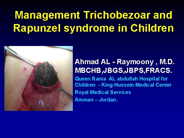 Management Trichobezoar and Rapunzel syndrome in Children Ahmad AL - Raymoony , M. D.