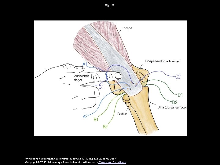 Fig 9 Arthroscopy Techniques 2019 8 e 85 -e 91 DOI: (10. 1016/j. eats.