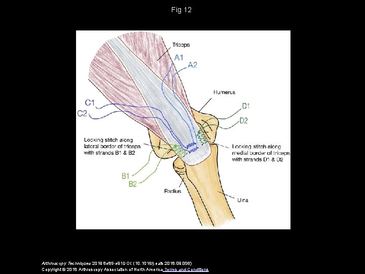 Fig 12 Arthroscopy Techniques 2019 8 e 85 -e 91 DOI: (10. 1016/j. eats.