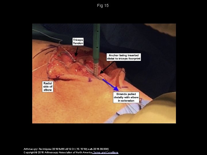 Fig 15 Arthroscopy Techniques 2019 8 e 85 -e 91 DOI: (10. 1016/j. eats.