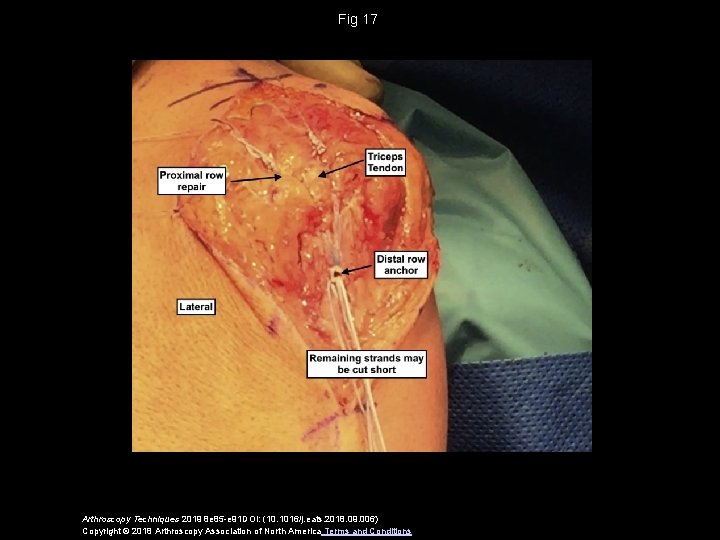 Fig 17 Arthroscopy Techniques 2019 8 e 85 -e 91 DOI: (10. 1016/j. eats.