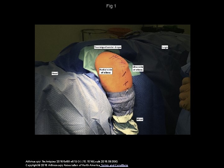 Fig 1 Arthroscopy Techniques 2019 8 e 85 -e 91 DOI: (10. 1016/j. eats.