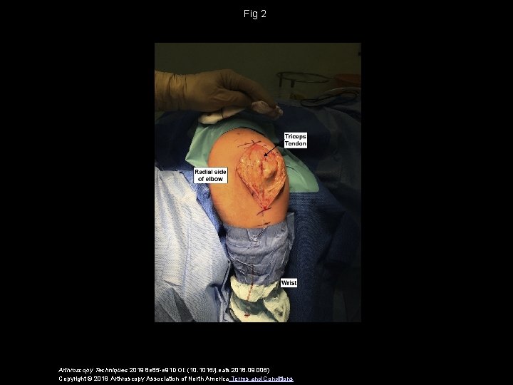 Fig 2 Arthroscopy Techniques 2019 8 e 85 -e 91 DOI: (10. 1016/j. eats.