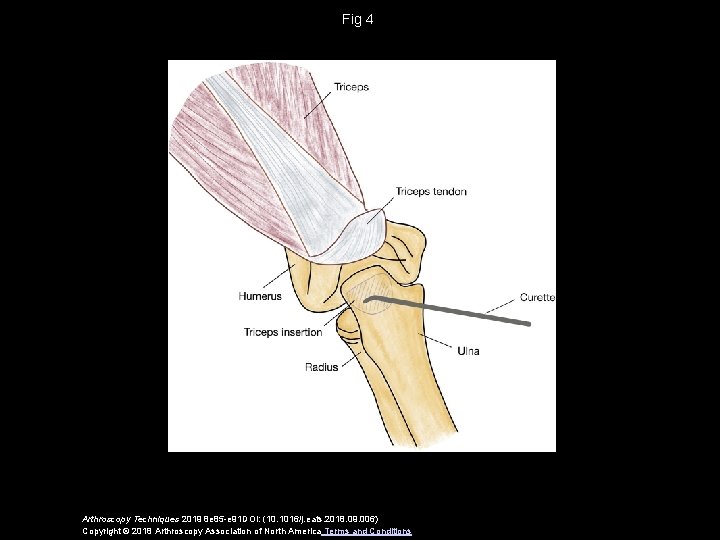 Fig 4 Arthroscopy Techniques 2019 8 e 85 -e 91 DOI: (10. 1016/j. eats.