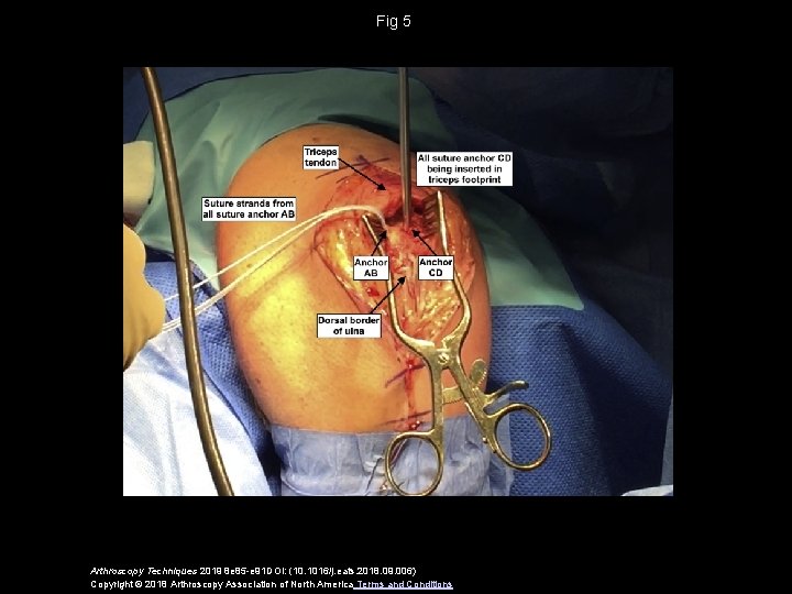 Fig 5 Arthroscopy Techniques 2019 8 e 85 -e 91 DOI: (10. 1016/j. eats.