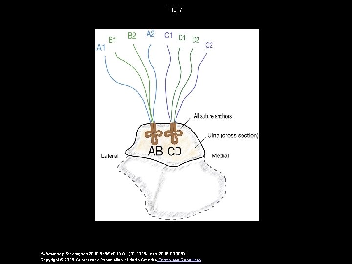 Fig 7 Arthroscopy Techniques 2019 8 e 85 -e 91 DOI: (10. 1016/j. eats.