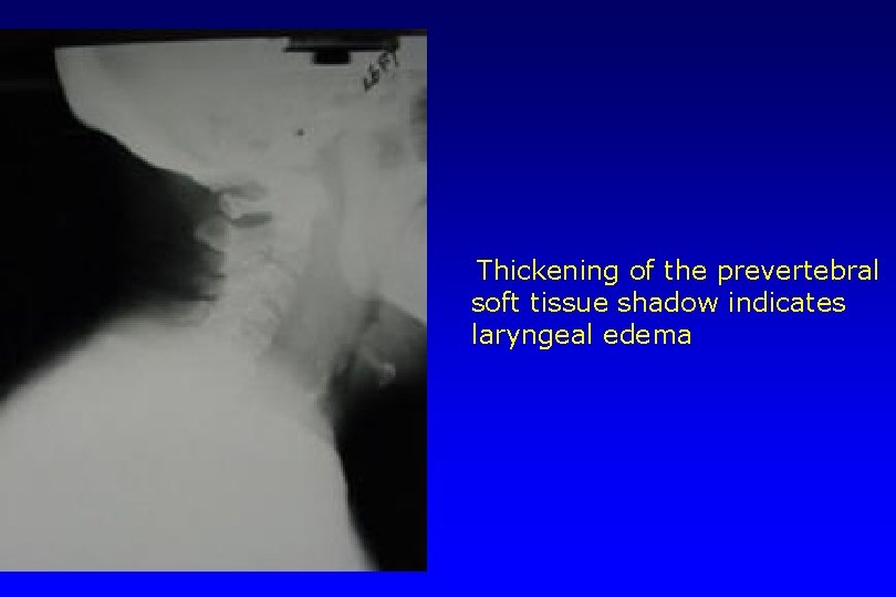  Thickening of the prevertebral soft tissue shadow indicates laryngeal edema 