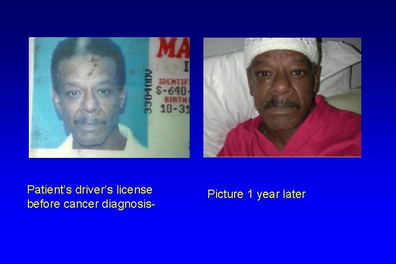 Patient’s driver’s license before cancer diagnosis- Picture 1 year later 