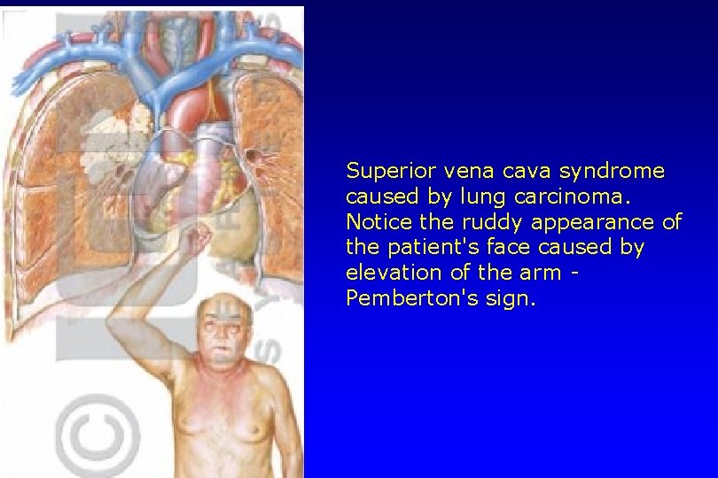 Superior vena cava syndrome caused by lung carcinoma. Notice the ruddy appearance of the