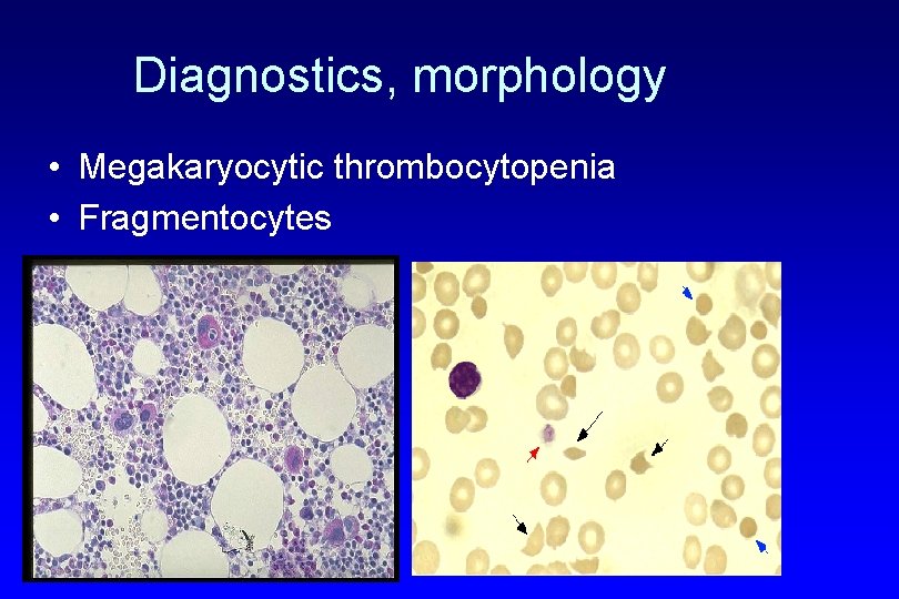 Diagnostics, morphology • Megakaryocytic thrombocytopenia • Fragmentocytes 