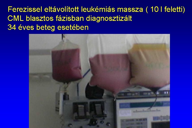 Ferezissel eltávolított leukémiás massza ( 10 l feletti) CML blasztos fázisban diagnosztizált 34 éves