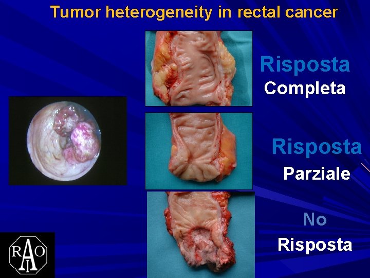 Tumor heterogeneity in rectal cancer Risposta Completa Risposta Parziale No Risposta 