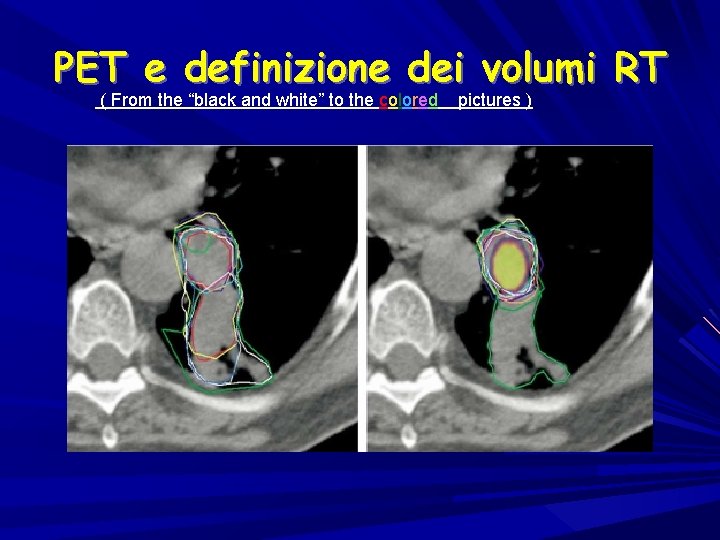 PET e definizione dei volumi RT ( From the “black and white” to the
