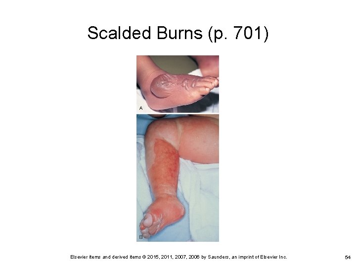 Scalded Burns (p. 701) Elsevier items and derived items © 2015, 2011, 2007, 2006