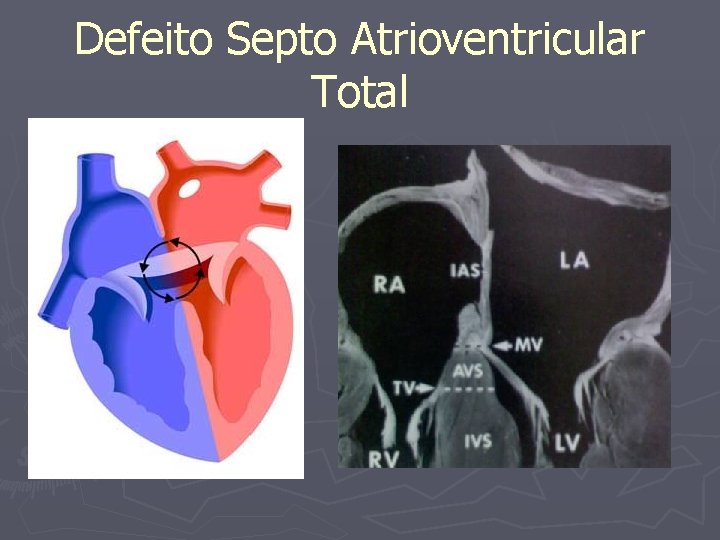 Defeito Septo Atrioventricular Total 