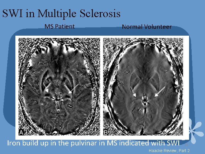 SWI in Multiple Sclerosis MS Patient Normal Volunteer Iron build up in the pulvinar