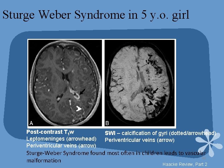 Sturge Weber Syndrome in 5 y. o. girl Post-contrast T 1 w Leptomeninges (arrowhead)