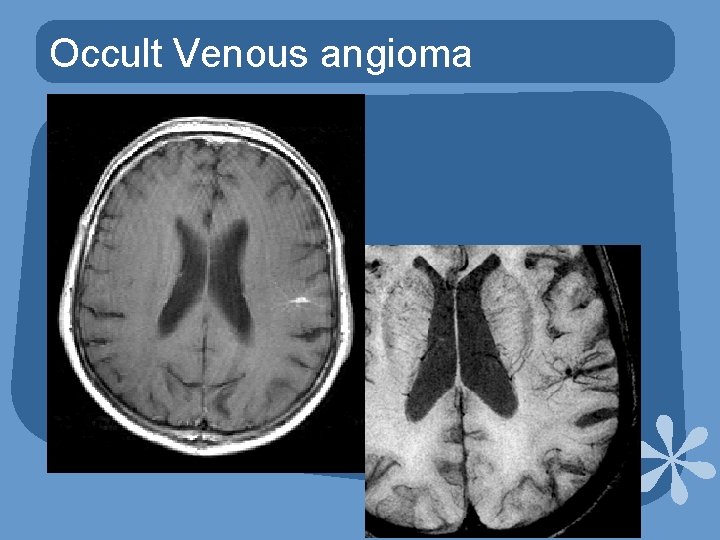 Occult Venous angioma 