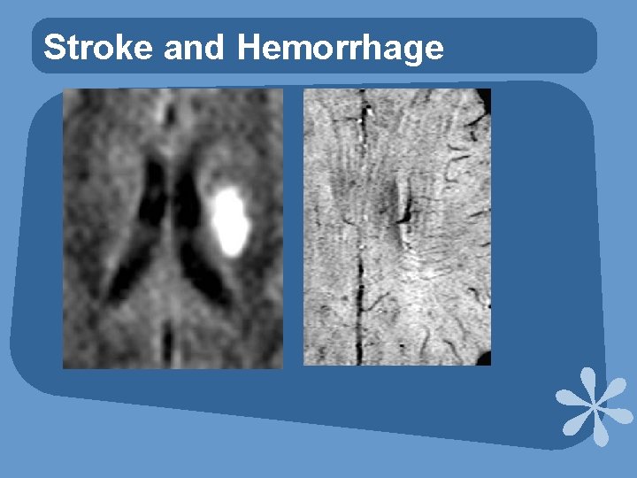 Stroke and Hemorrhage 