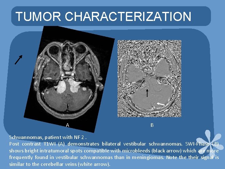 TUMOR CHARACTERIZATION A B Schwannomas, patient with NF 2. Post contrast T 1 WI