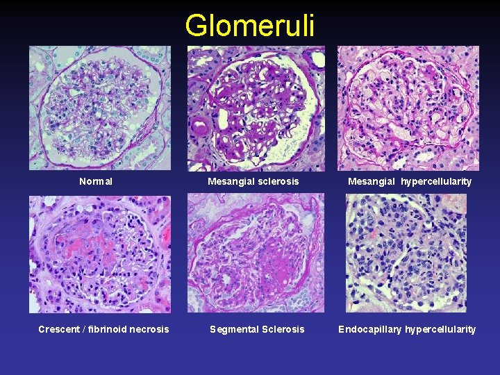 Glomeruli Normal Crescent / fibrinoid necrosis Mesangial sclerosis Segmental Sclerosis Mesangial hypercellularity Endocapillary hypercellularity