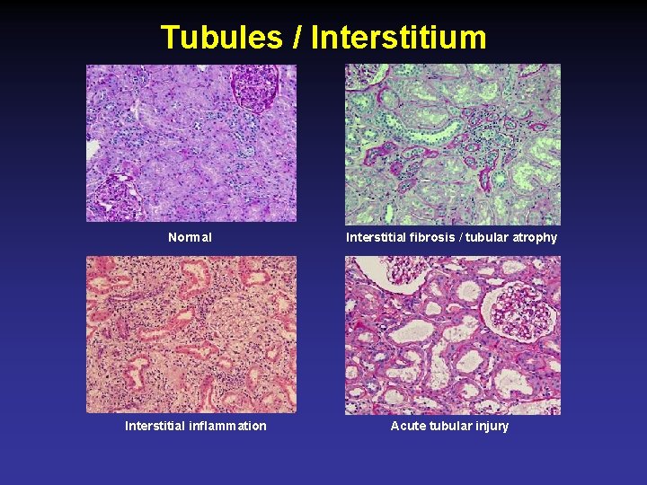 Tubules / Interstitium Normal Interstitial inflammation Interstitial fibrosis / tubular atrophy Acute tubular injury