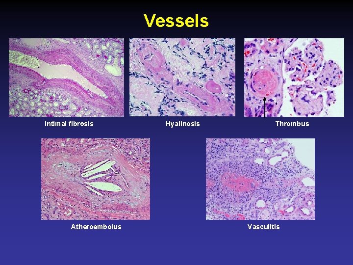 Vessels Intimal fibrosis Atheroembolus Hyalinosis Thrombus Vasculitis 