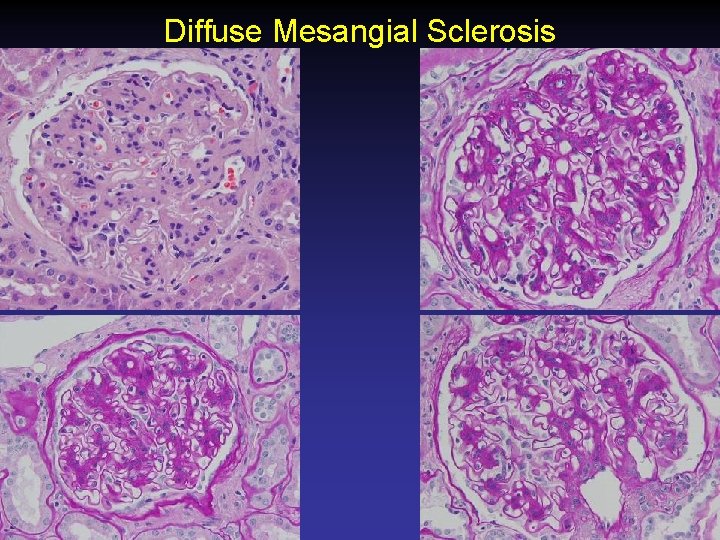 Diffuse Mesangial Sclerosis 