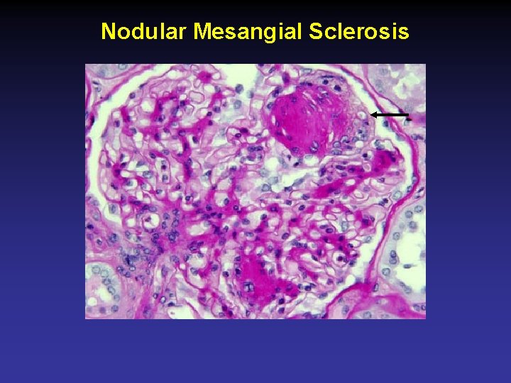 Nodular Mesangial Sclerosis 