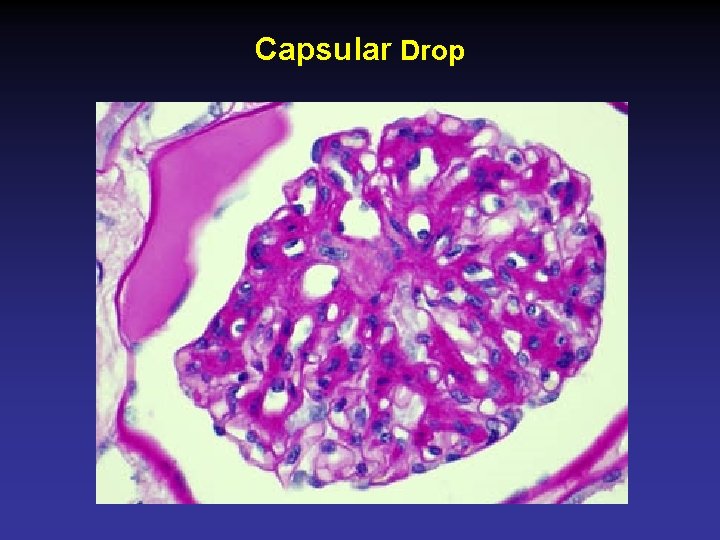 Capsular Drop 