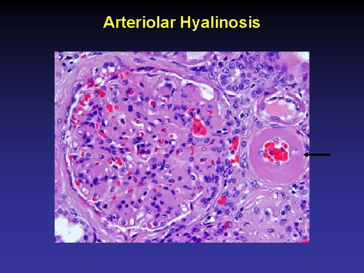 Arteriolar Hyalinosis 