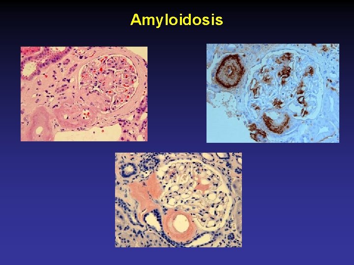 Amyloidosis 