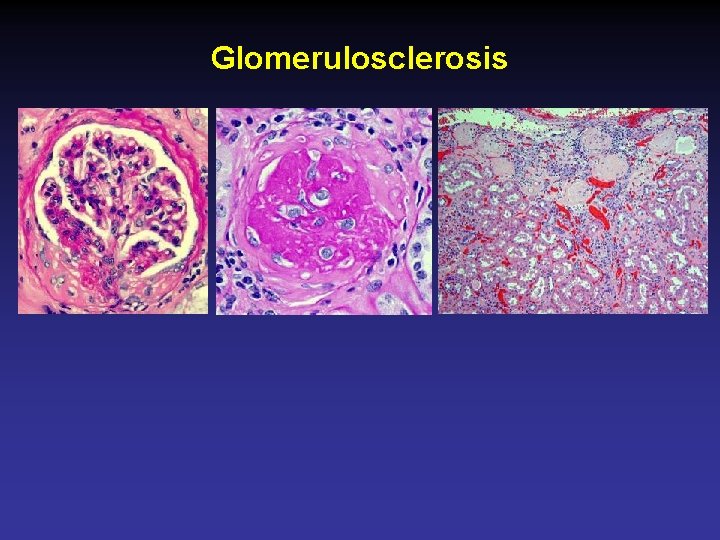 Glomerulosclerosis 