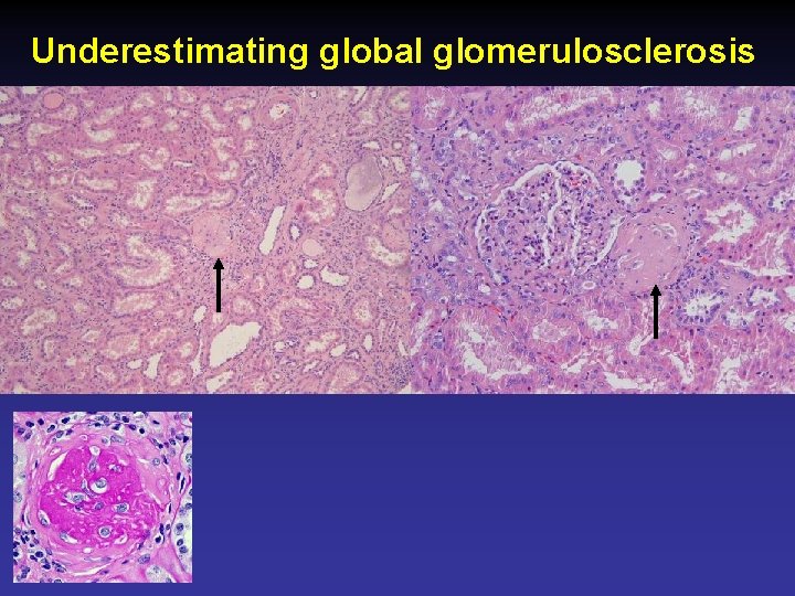 Underestimating global glomerulosclerosis 