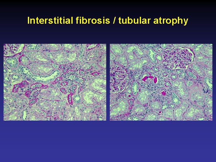 Interstitial fibrosis / tubular atrophy 