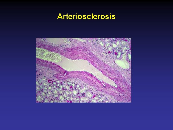 Arteriosclerosis 