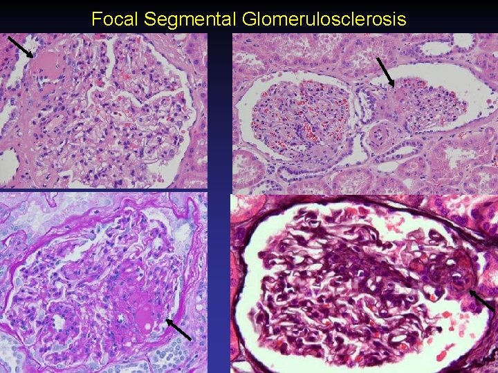 Focal Segmental Glomerulosclerosis 